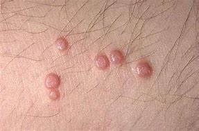 Image result for Warts or Molluscum