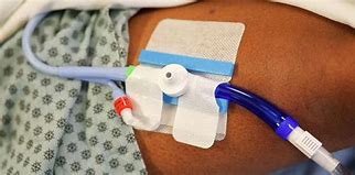 Image result for Catheter Stabilization Device Foley 2-Way