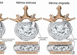 Image result for herniado