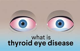 Image result for Autoimmune Thyroid Eye Disease