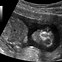 Image result for Anencephaly in Anteatal USG