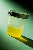 Image result for Chlamydia in Urine