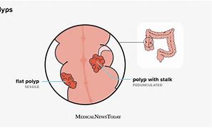 Image result for Sessile Colon Polyp