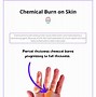Image result for Chemical Burn Bleach On Skin