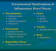 Image result for IBD Extraintestinal Manifestations