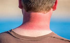 Image result for SunBurn Symptoms