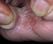 Image result for Signs and Symptoms of Athlete's Foot