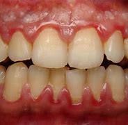 Image result for Gingival Papilloma Problems