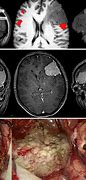 Image result for Meningioma Sugery