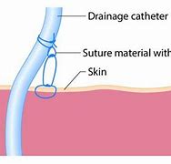 Image result for Percutaneous Catheter Drainage