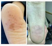 Image result for Swift Wart Treatment