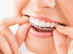 Image result for Byte Aligners Reviews and Pictures