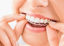 Image result for Byte Teeth Aligners