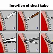 Image result for Thoracostomy Chest Tube Removal