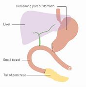 Image result for Pancreatic Cancer Anatomy