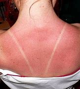 Image result for Sun Poisoning