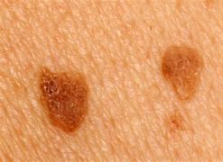 Image result for Skin Warts On Legs