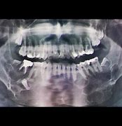 Image result for Show Pic of Jaw Bone Cancer