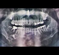 Image result for Jaw Bone Cancer