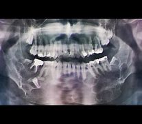 Image result for Lower Jaw Bone Cancer