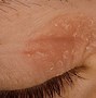 Image result for What Causes Eczema around Eyes