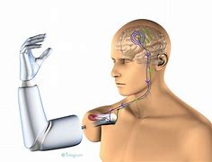 Image result for Robotic Arm Prosthetics