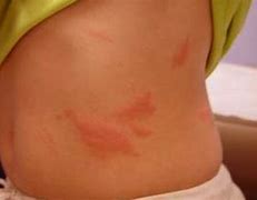 Image result for Rashes On Stomach