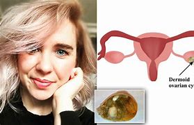 Image result for Ovarian Cyst Teeth Hair