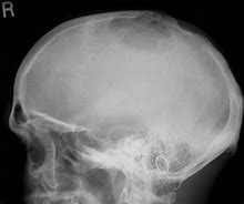 Image result for Skull with Bone Cancer