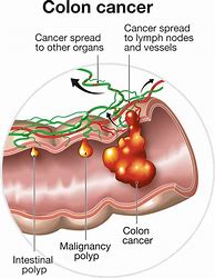Image result for Tumor On Outside of Colon