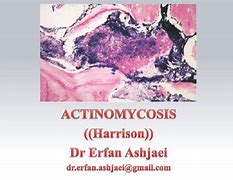 Image result for actinome5r�a