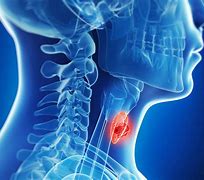 Image result for Head and Neck Cancer Tissue Biopsy