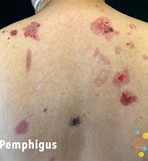 Pemphigus 的图像结果