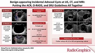 Image result for Right Adnexal Cyst