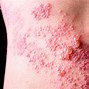 Image result for What Does Infected Shingles Look Like