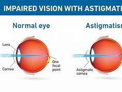 Image result for What Does Astigmatism Vision Look Like