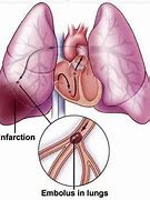 Image result for Pulmonary Embolism Nursing