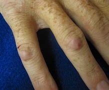 Image result for Rheumatoid Arthritis Symptoms Nodules On Skin