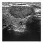 Image result for Solid Thyroid Nodule Ultrasound