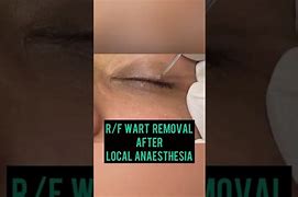 Image result for Eyelid Wart Removal Surgery