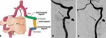 Image result for V3 Segment Vertebral Artery