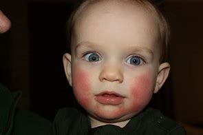 Image result for Fifth Disease Rash Face
