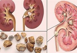 Image result for Big Kidney Stones