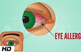Image result for Chlamydia Eye Infection Symptoms
