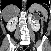 Image result for Haemoragic Renal Cyst MRI