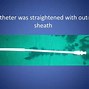 Image result for Wayne Pigtail Catheter