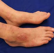 Image result for What Does Atopic Dermatitis Look Like