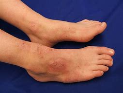 Image result for dermatitis