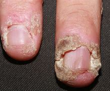 Image result for Types of Warts On Fingers