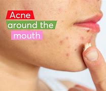 Image result for Acne around Mouth